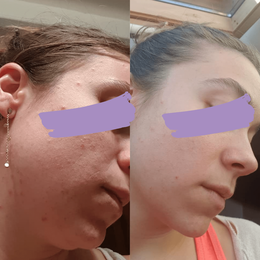 Avant après méthode Happyderme acné femme naturopathie