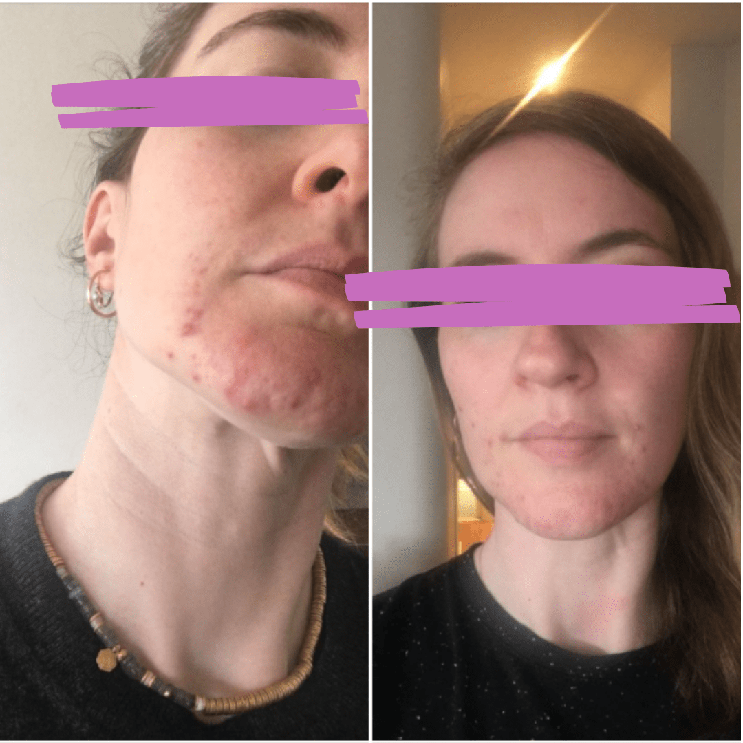 avant-apres4 Avant après méthode Happyderme acné femme naturopathie