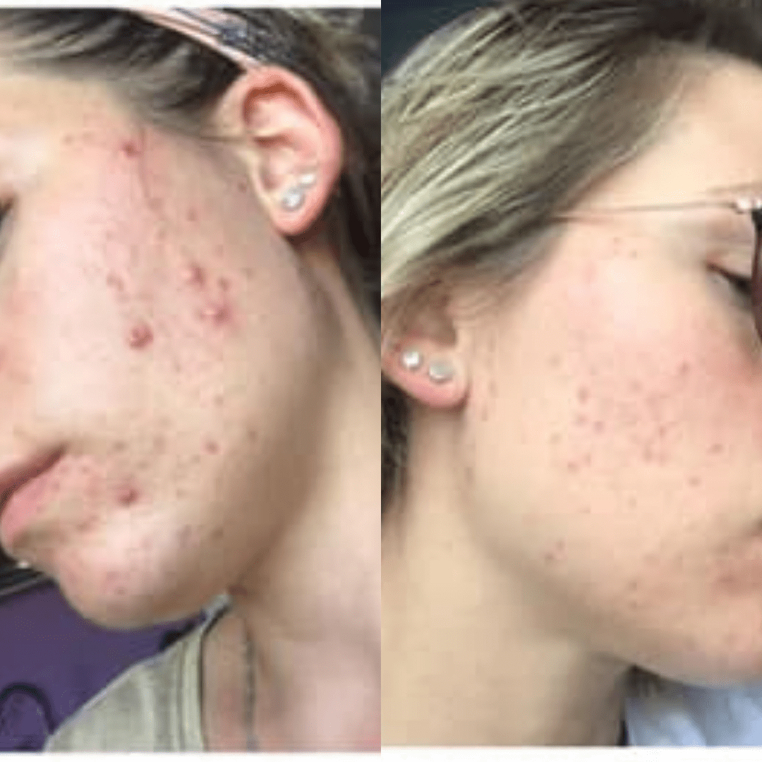 avis méthode Happyderme Marion Lecoin avant après acné solution naturelle