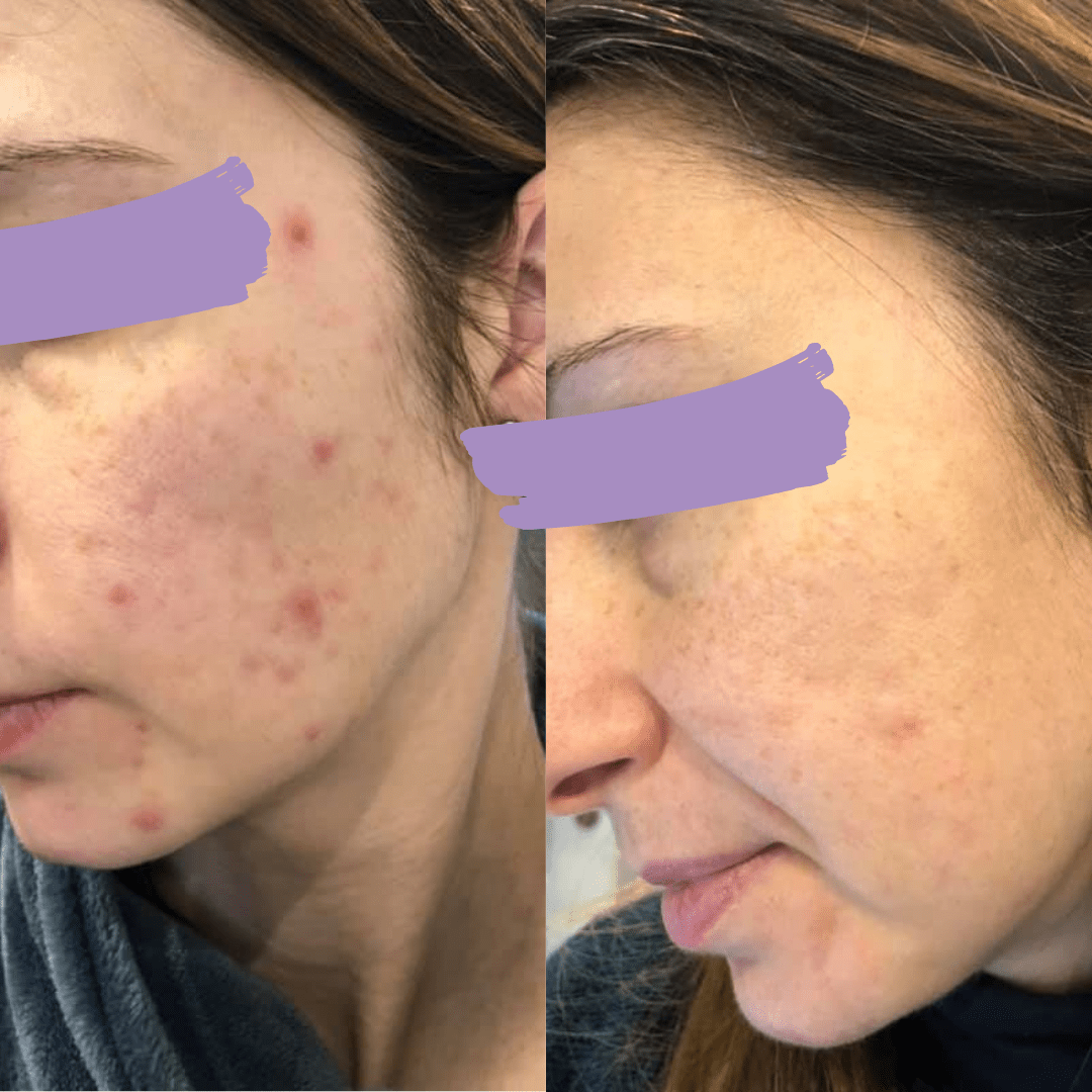 avant-apres_acne_Elise_methode_Happyderme Avant après méthode Happyderme acné femme naturopathie