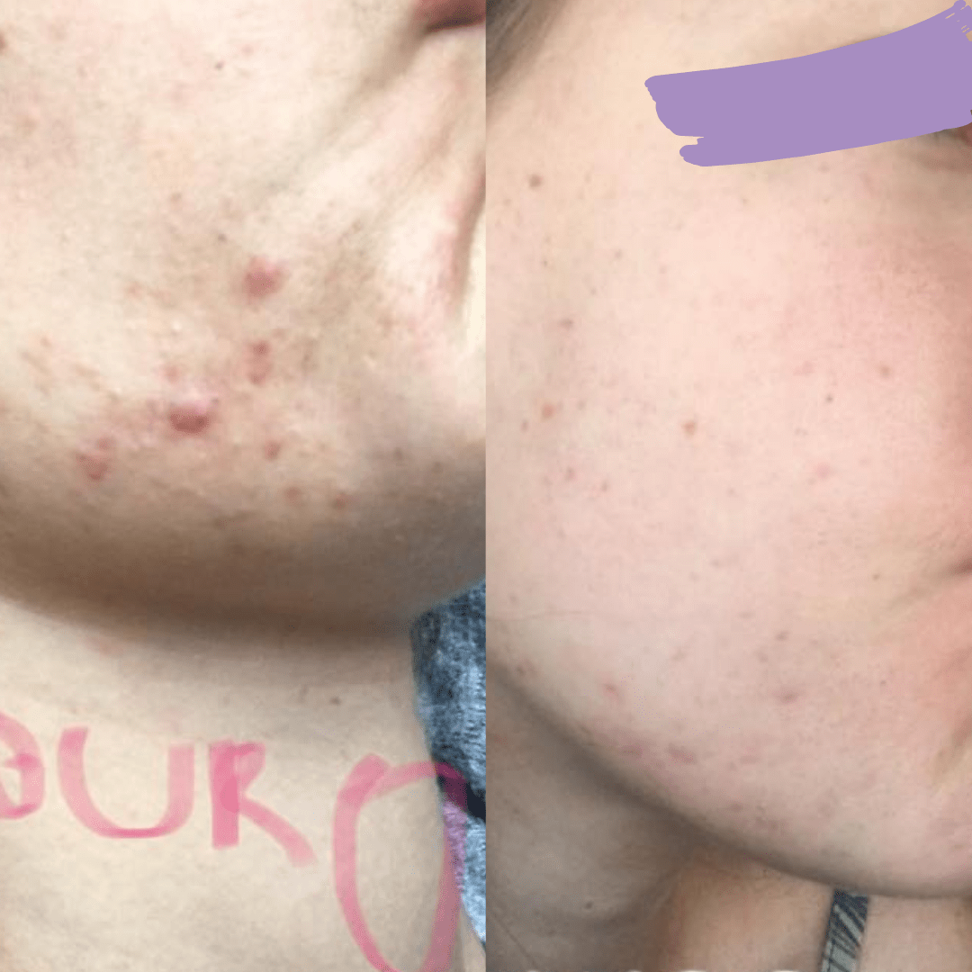 avant-apres_acne_Estelle_methode_Happyderme Avant après méthode Happyderme acné femme naturopathie