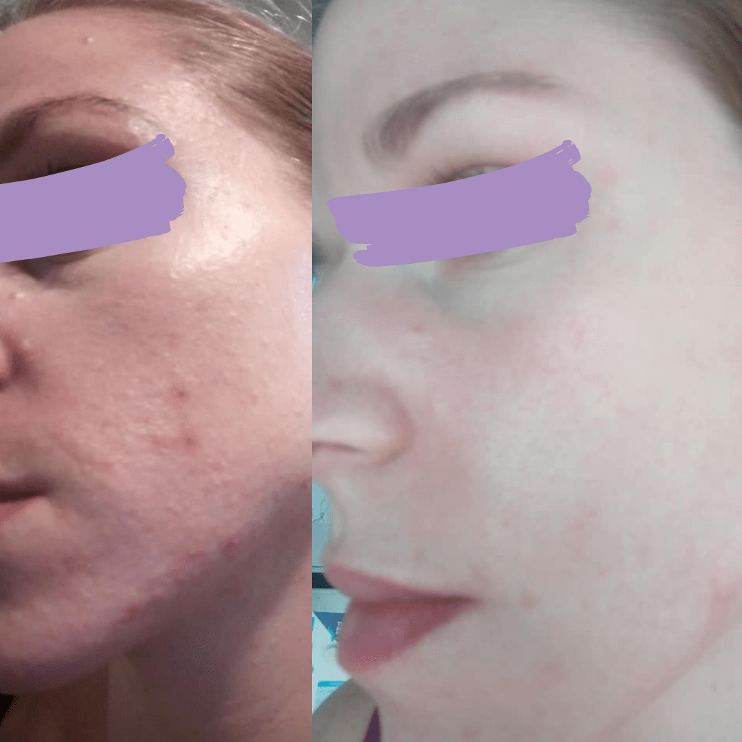avant-apres_acne_Maeva_methode_Happyderme Avant après méthode Happyderme acné femme naturopathie