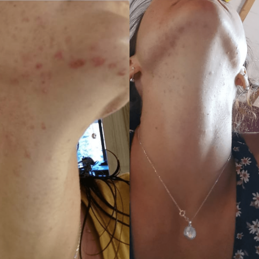 Avant après méthode Happyderme acné femme naturopathie