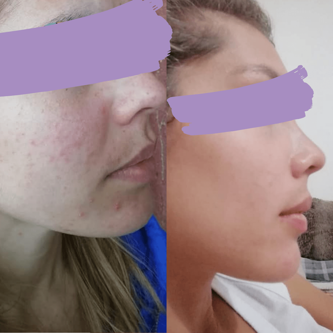 avant-apres_acne_Nathalie_methode_Happyderme Avant après méthode Happyderme acné femme naturopathie